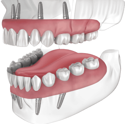 На какой челюсти нужно восстановить зубы?