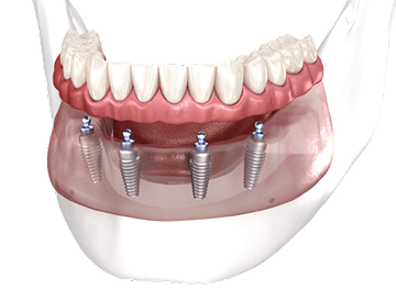 4 импланта + протез