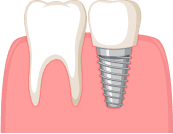 Имплантация